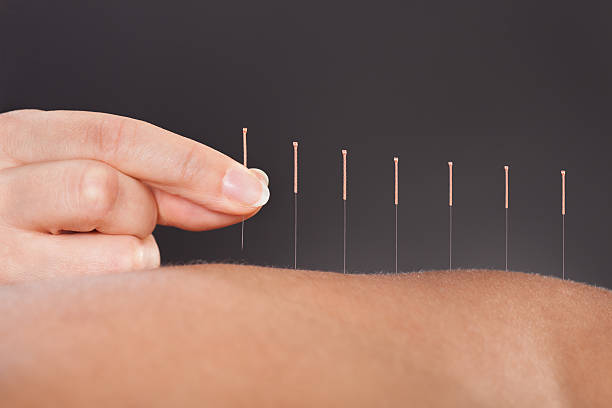 Placement of acupuncture needles